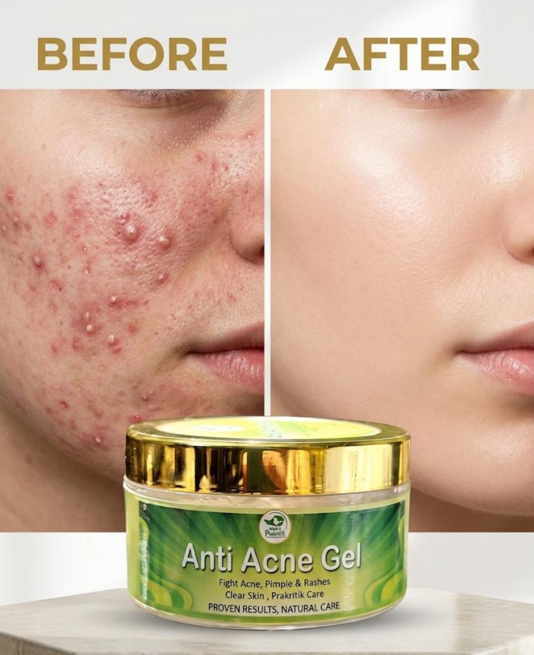Anti Acne Gel - Image 2